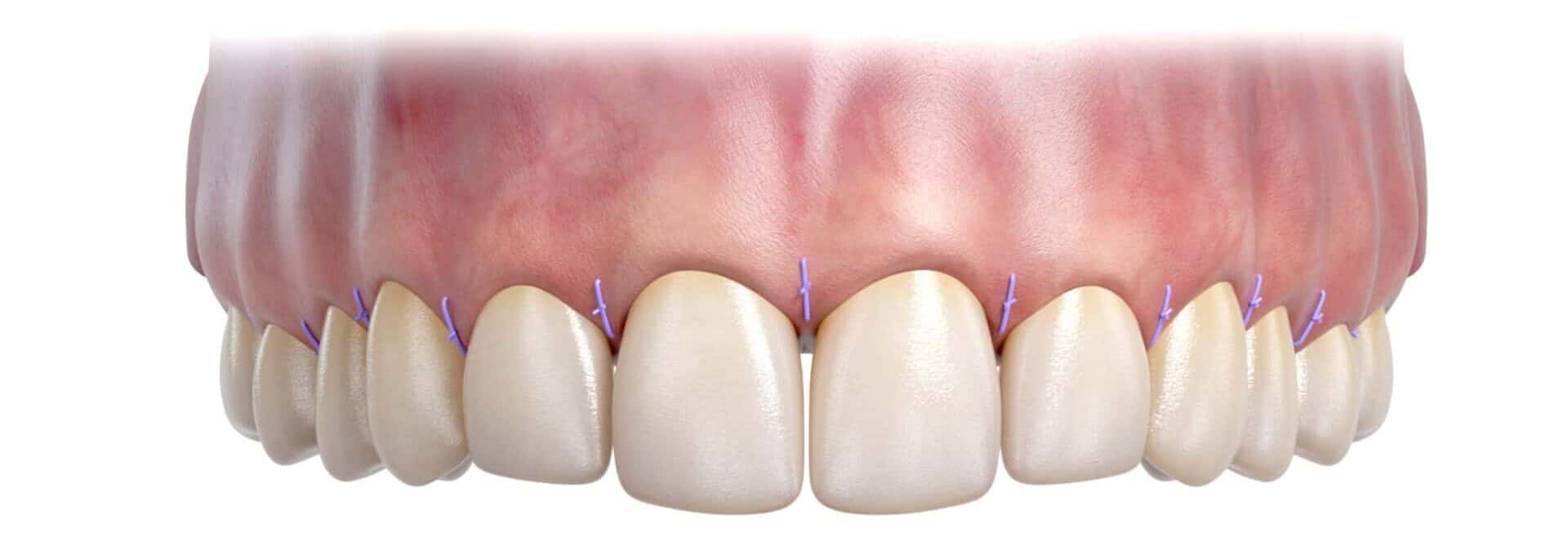 Illustration of gums after crown lengthening with sutures in place scaled e1739641264775