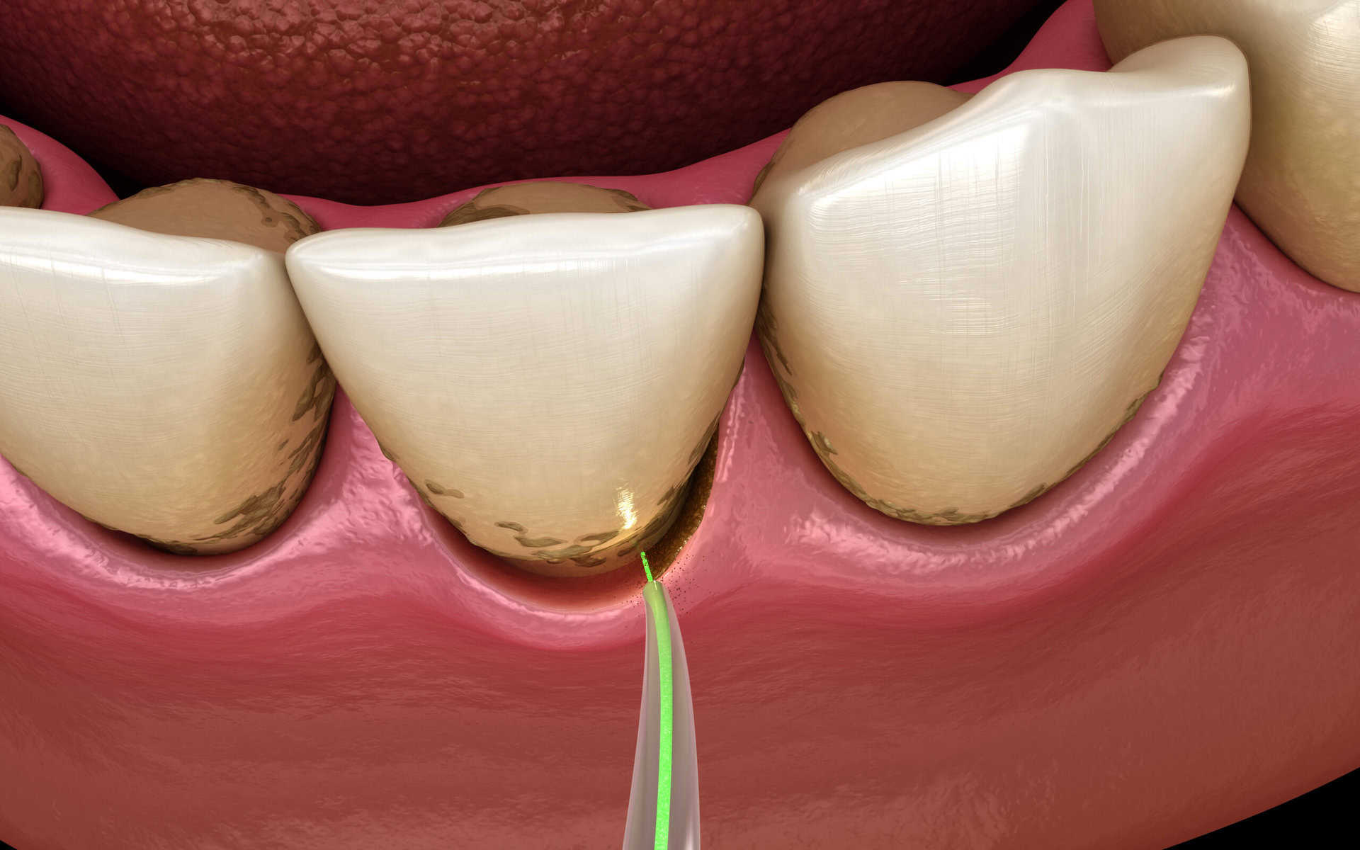 Ilustration of laser eliminating bacteria in deep periodontal pocket scaled