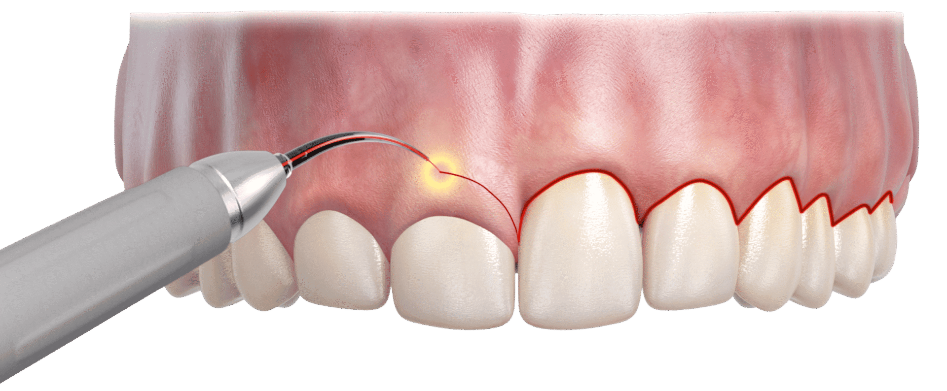 cosmetic laser surgery on front teeth for gummy smile