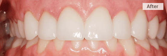 cosmetic periodontics front teeth after image