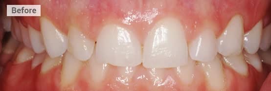 cosmetic periodontics front teeth before image