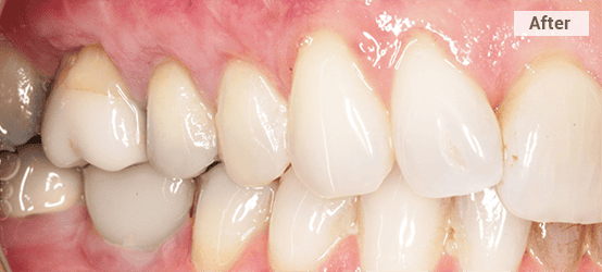 gum grafting back teeth after picture