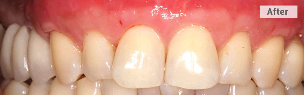 gum grafting front teeth after picture