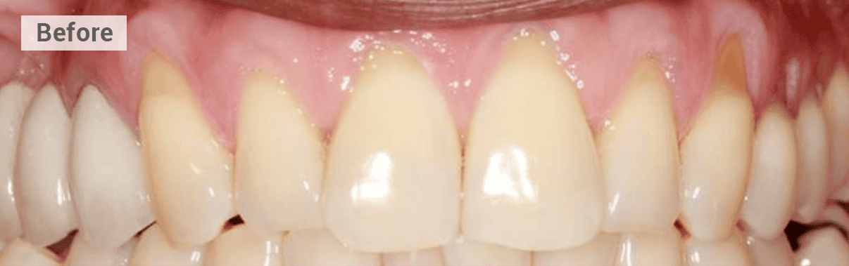 gum grafting front teeth the ford picture