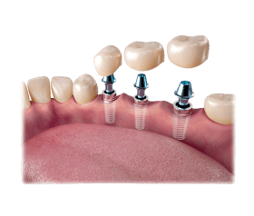 illustration of 3 dental implants with crown being placed