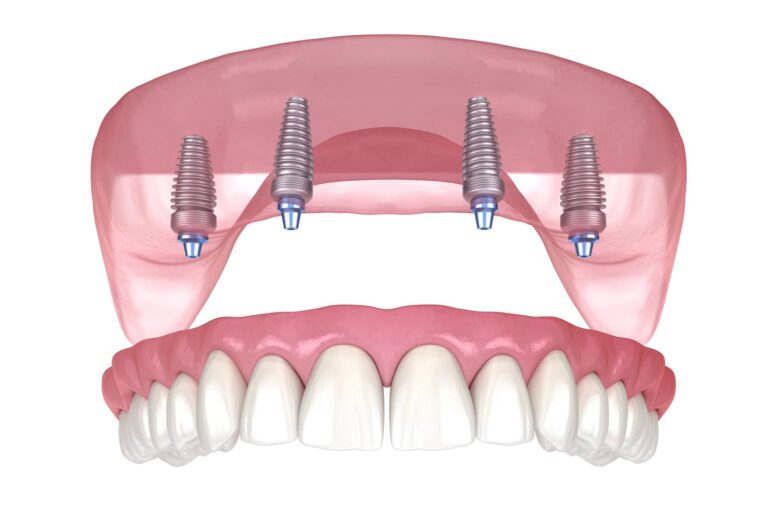 illustration of all on 4 upper dental teeth in a day procedure