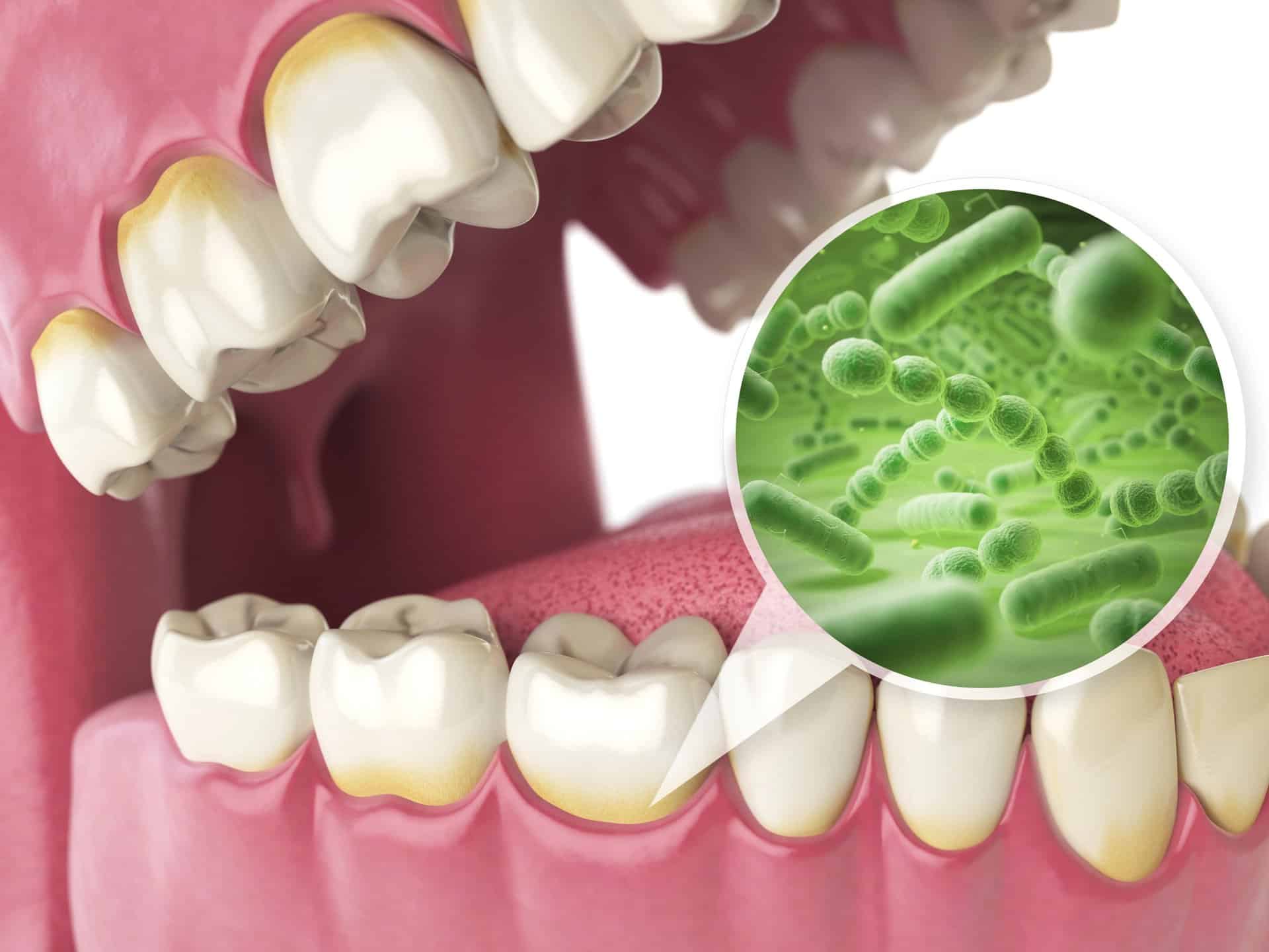 illustration of bacteria in gums