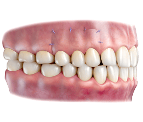 illustration of full thickness gingival graft