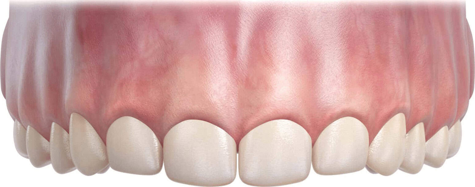 illustration of gingival hyperplasia scaled