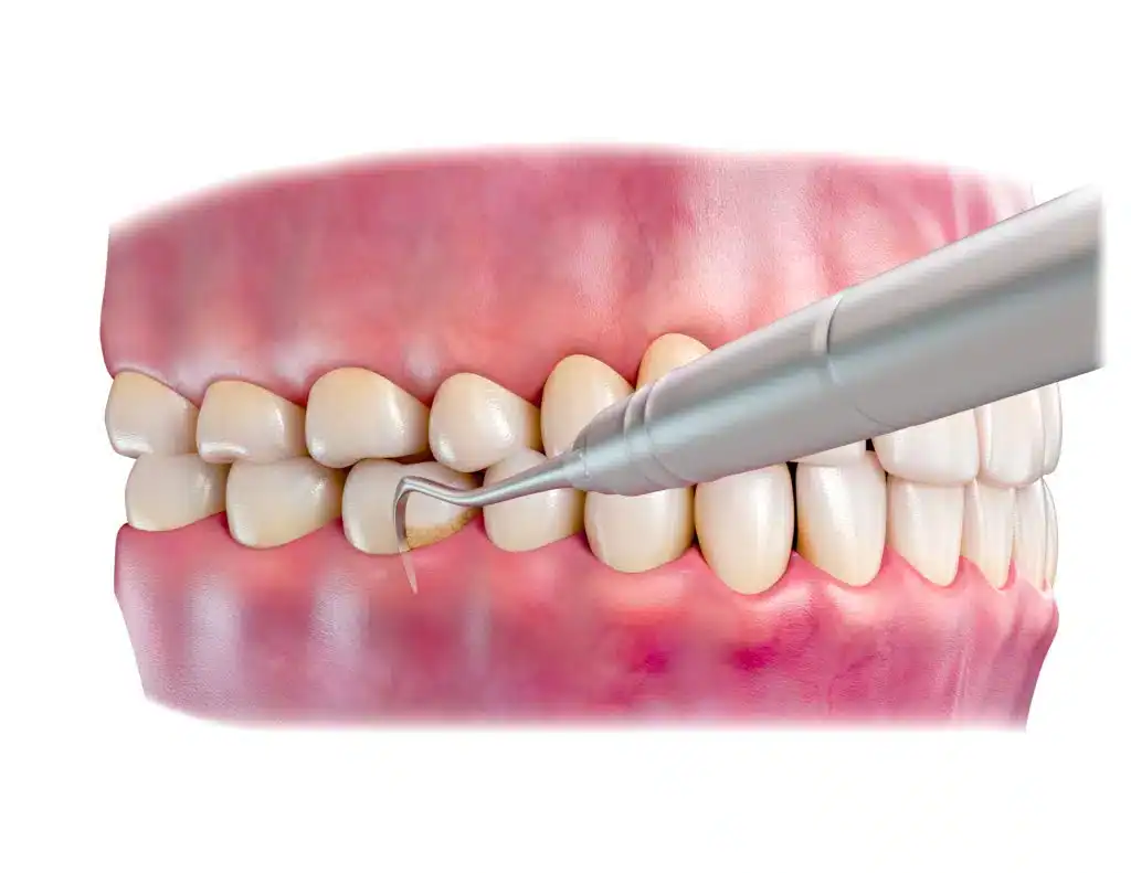 illustration of gingival scaling and root planning