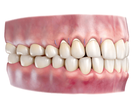 illustration of gum connected tissue graft