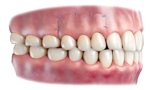 illustration of gum full thickness periodontal graft