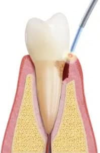 illustration of laser removal of diseased tissue first step of lanap