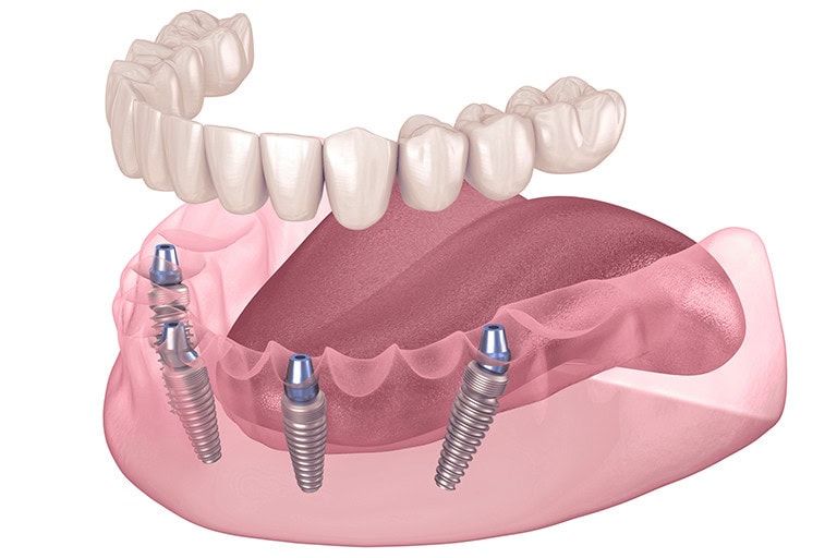 illustration of mandible with prosthesis and all on 4 implant configuration