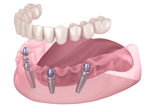 illustration of mandible with prosthesis and all on 4 implant configuration
