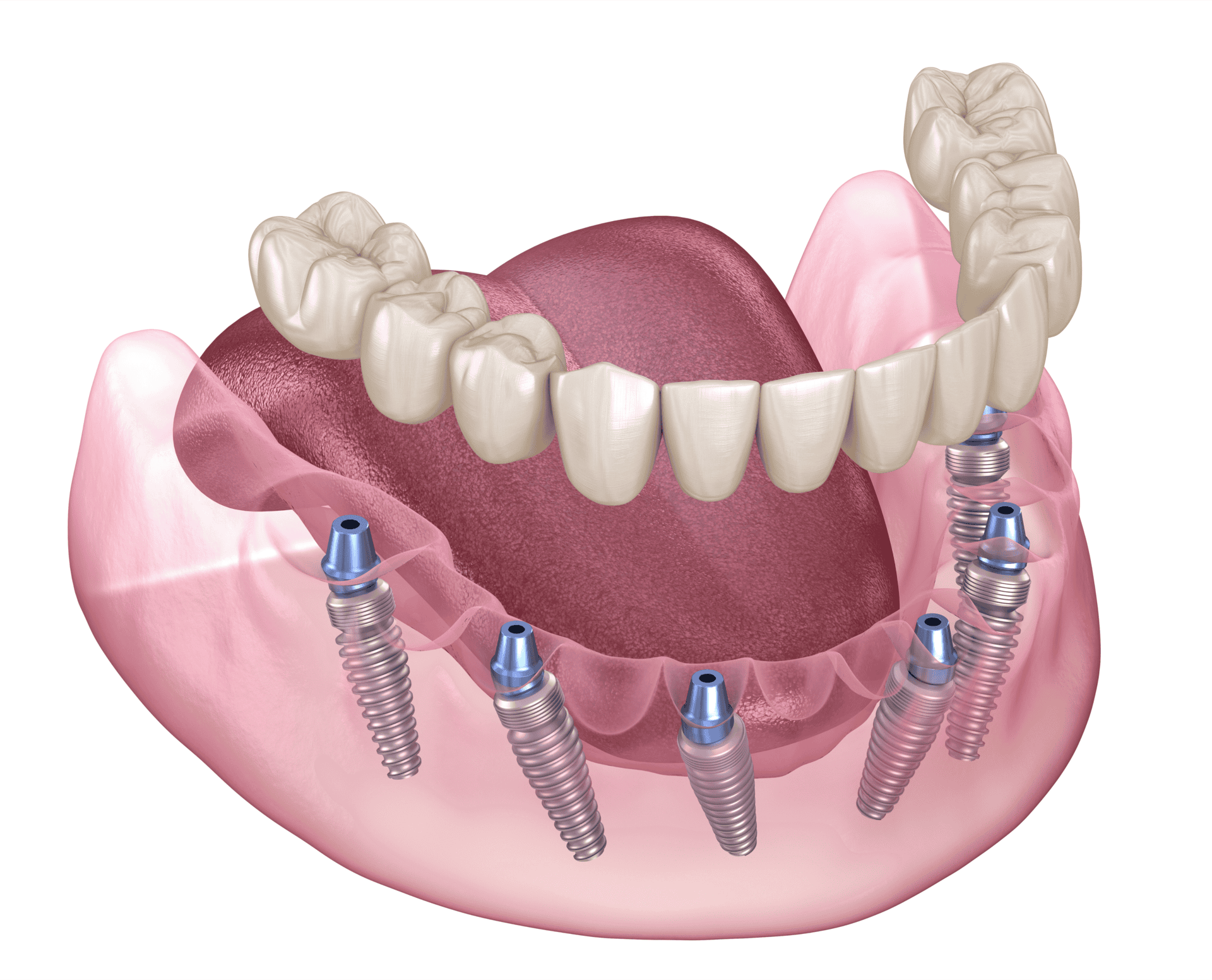 illustration of mandible with prosthesis and all on 6 implant configuration