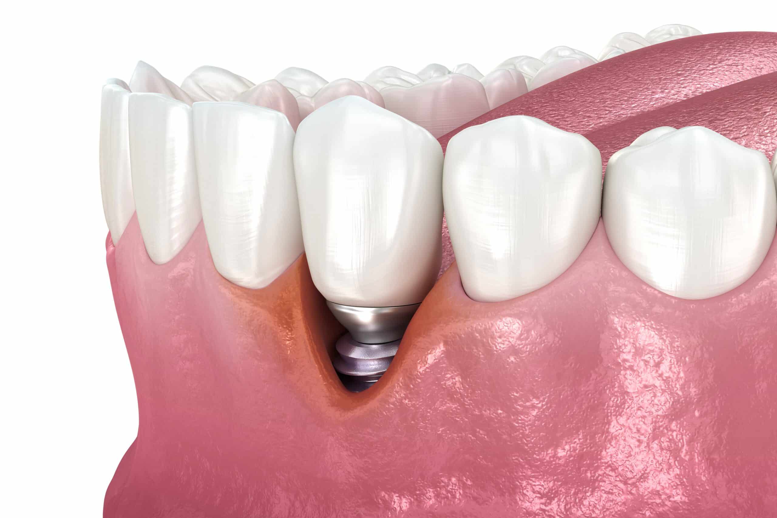 illustration of peri implantitis on front tooth scaled