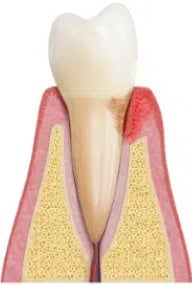 illustration of periodontal disease