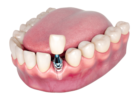 illustration of single dental implant crown being placed