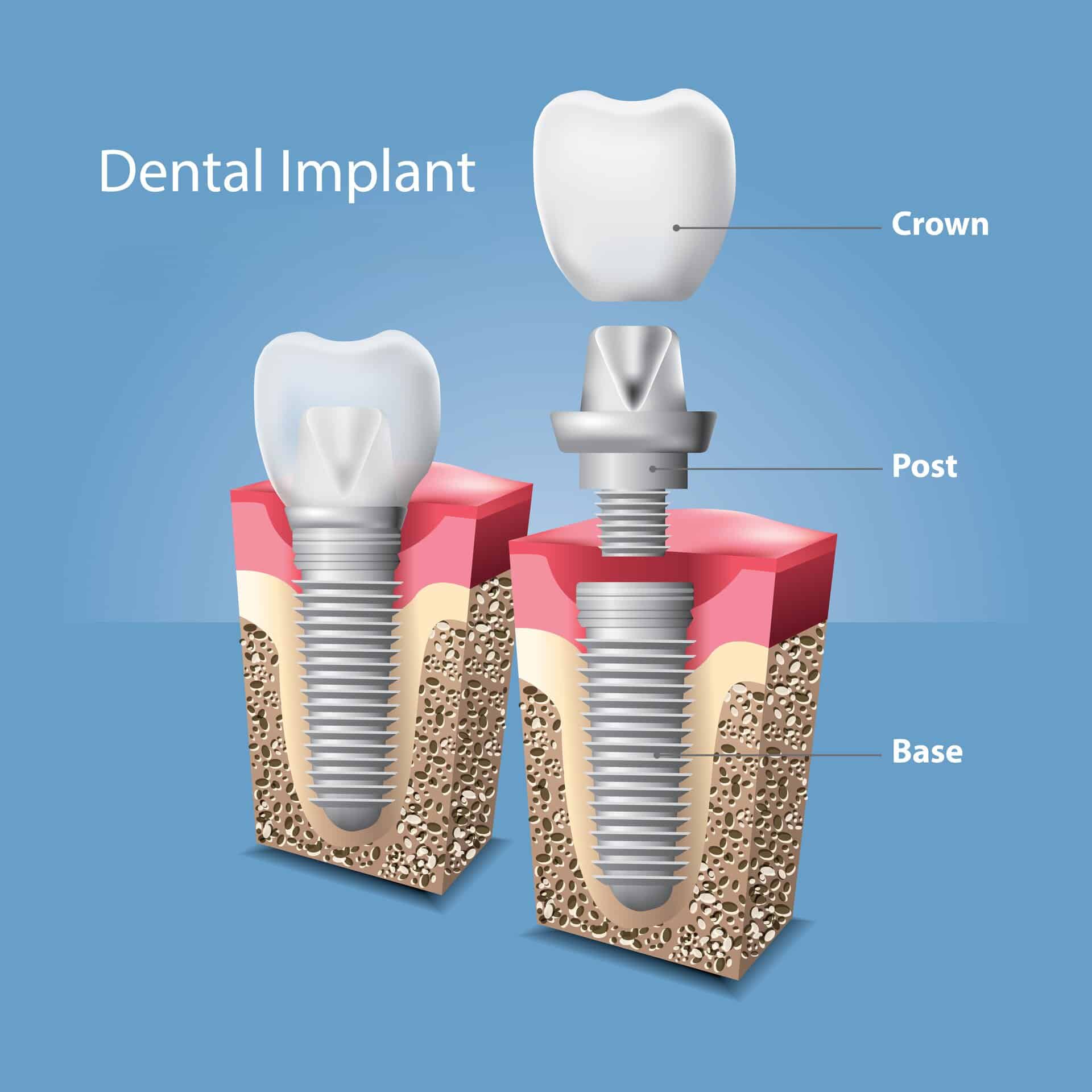 illustration of the components of a dental implant