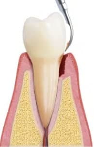 illustration of ultrasonic root cleaning of teeth
