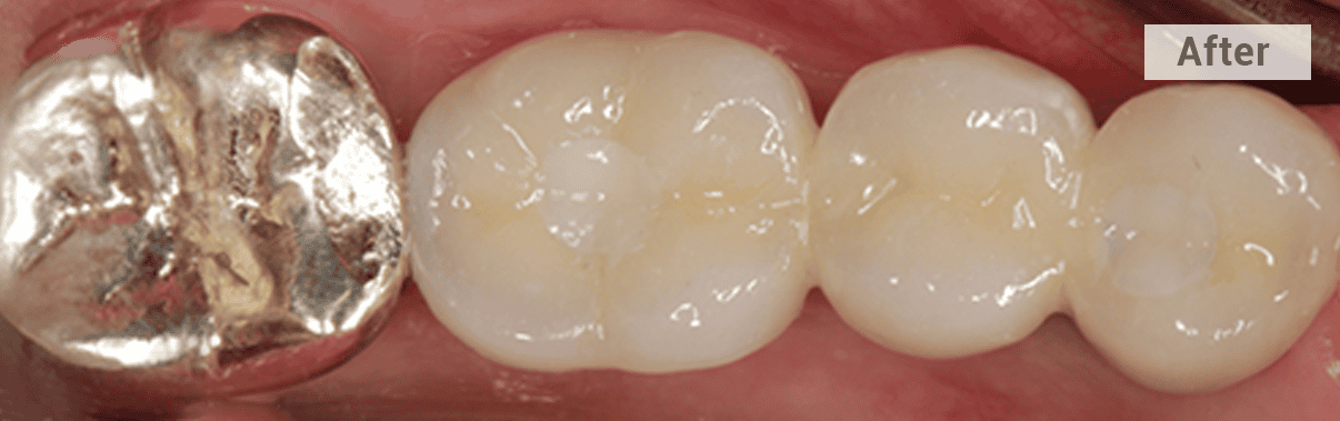 multiple implant restoration after picture