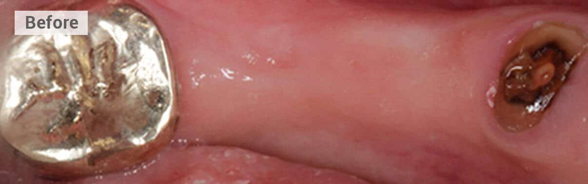 multiple implant restoration before picture