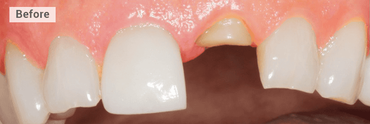 potential implant replacement front tooth before image
