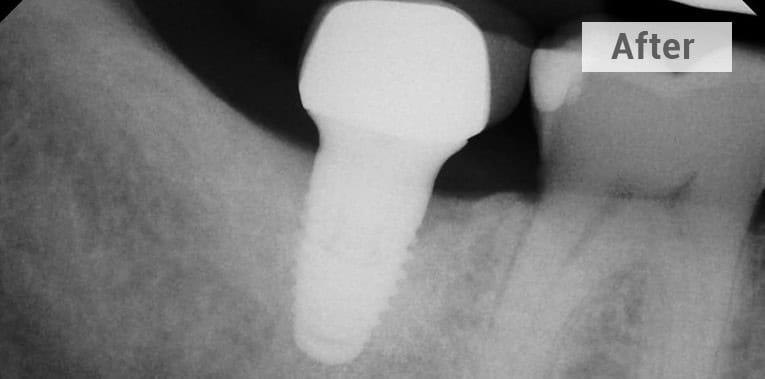 x ray of a failed dental implant after picture