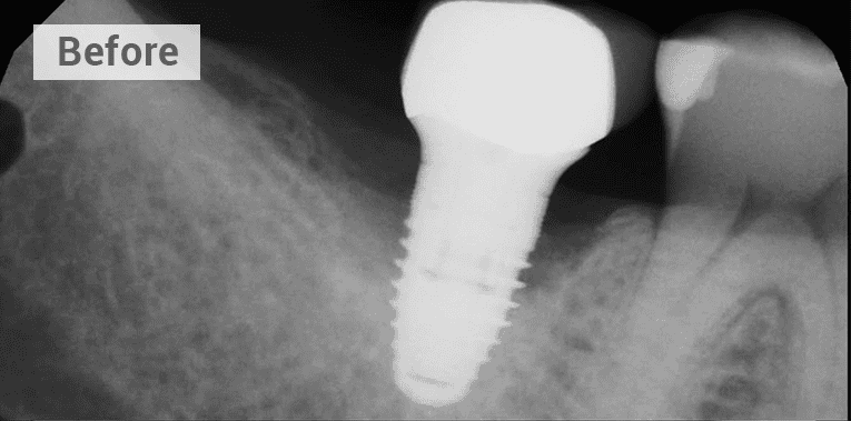 x ray of a failed dental implant before picture